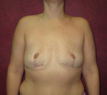 Breast Augmentation