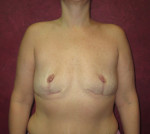 Breast Augmentation