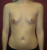 Breast Augmentation