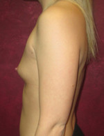 Breast Augmentation