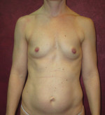 Breast Augmentation