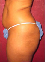 Liposuction