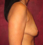 Breast Augmentation