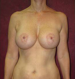 Breast Augmentation