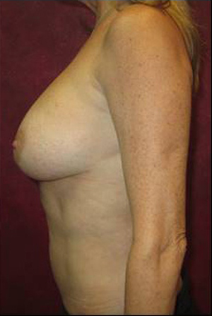 Breast Augmentation