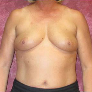 Breast Augmentation