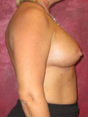 Breast Augmentation