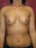 Breast Augmentation