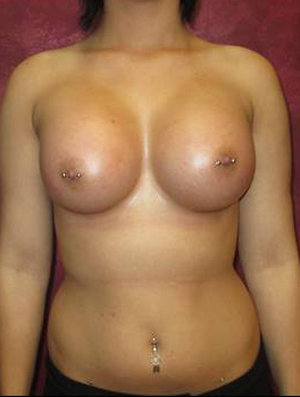 Breast Augmentation