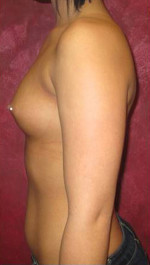 Breast Augmentation