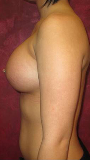 Breast Augmentation