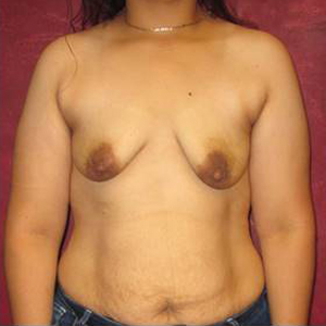 Breast Augmentation