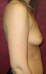 Breast Augmentation