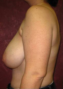 Breast Lift Result Houston