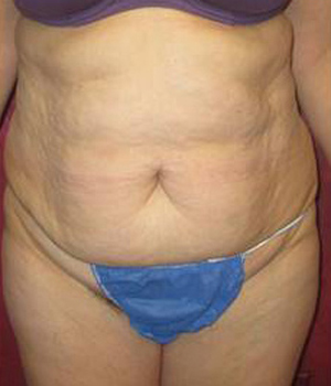 Tummy Tuck