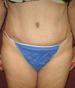 Tummy Tuck