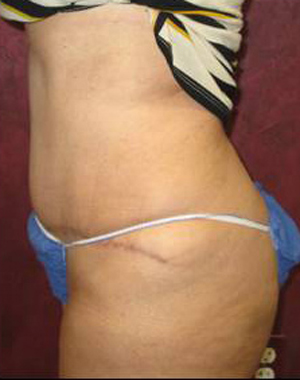 Tummy Tuck