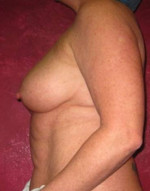 Breast Augmentation