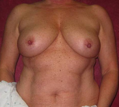 Breast Augmentation