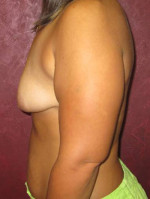 Breast Augmentation