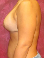 Breast Augmentation