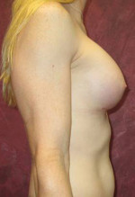 Breast Augmentation