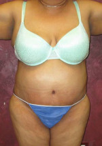 Tummy Tuck