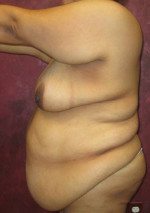 Tummy Tuck