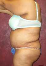 Tummy Tuck