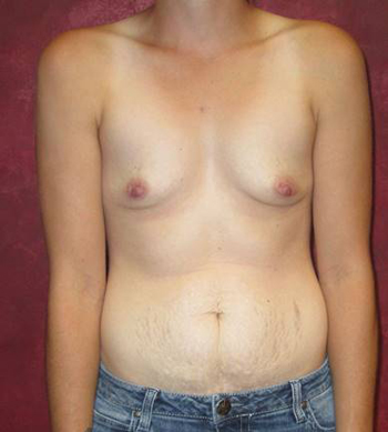 Breast Augmentation