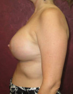 Breast Augmentation