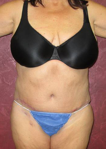 Tummy Tuck