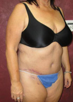 Tummy Tuck