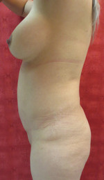 Liposuction