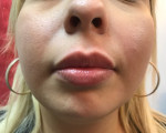 Lip Augmentation