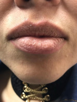 Lip Augmentation