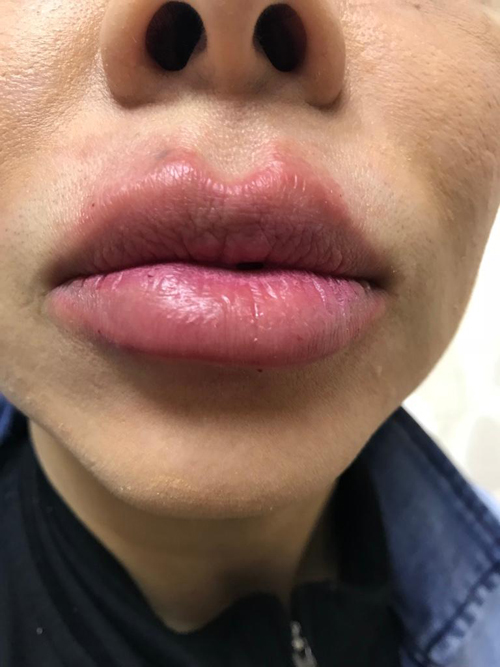 Lip Augmentation