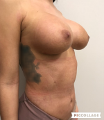 Breast Augmentation