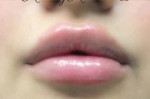 Lip Augmentation