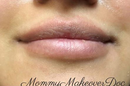 Lip Augmentation