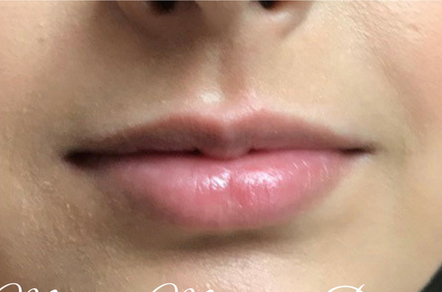 Lip Augmentation