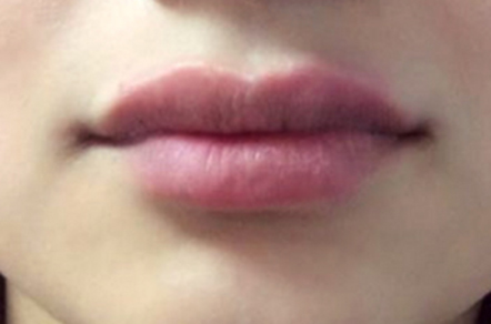 Lip Augmentation