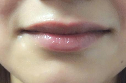 Lip Augmentation