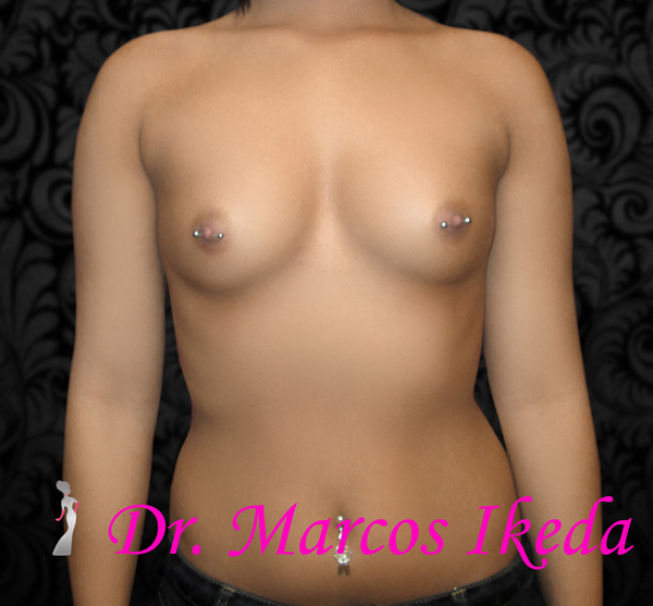 Breast Augmentation