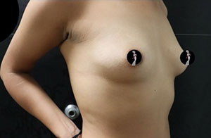 Breast Augmentation