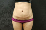 Tummy Tuck