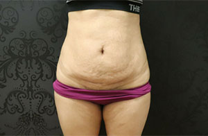 Tummy Tuck