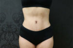 Tummy Tuck