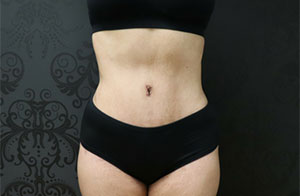 Tummy Tuck