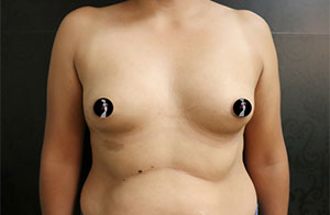 Breast Augmentation